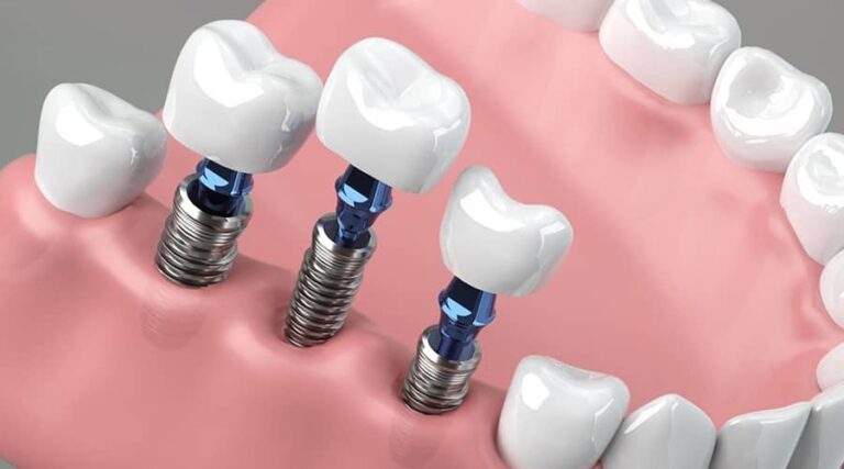 Dental Implant Surgery