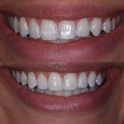 Teeth Whitening