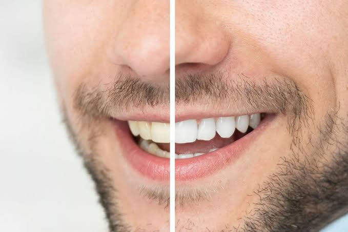 Teeth Whitening Services by a Dentist in Rolla for Brighter Smiles