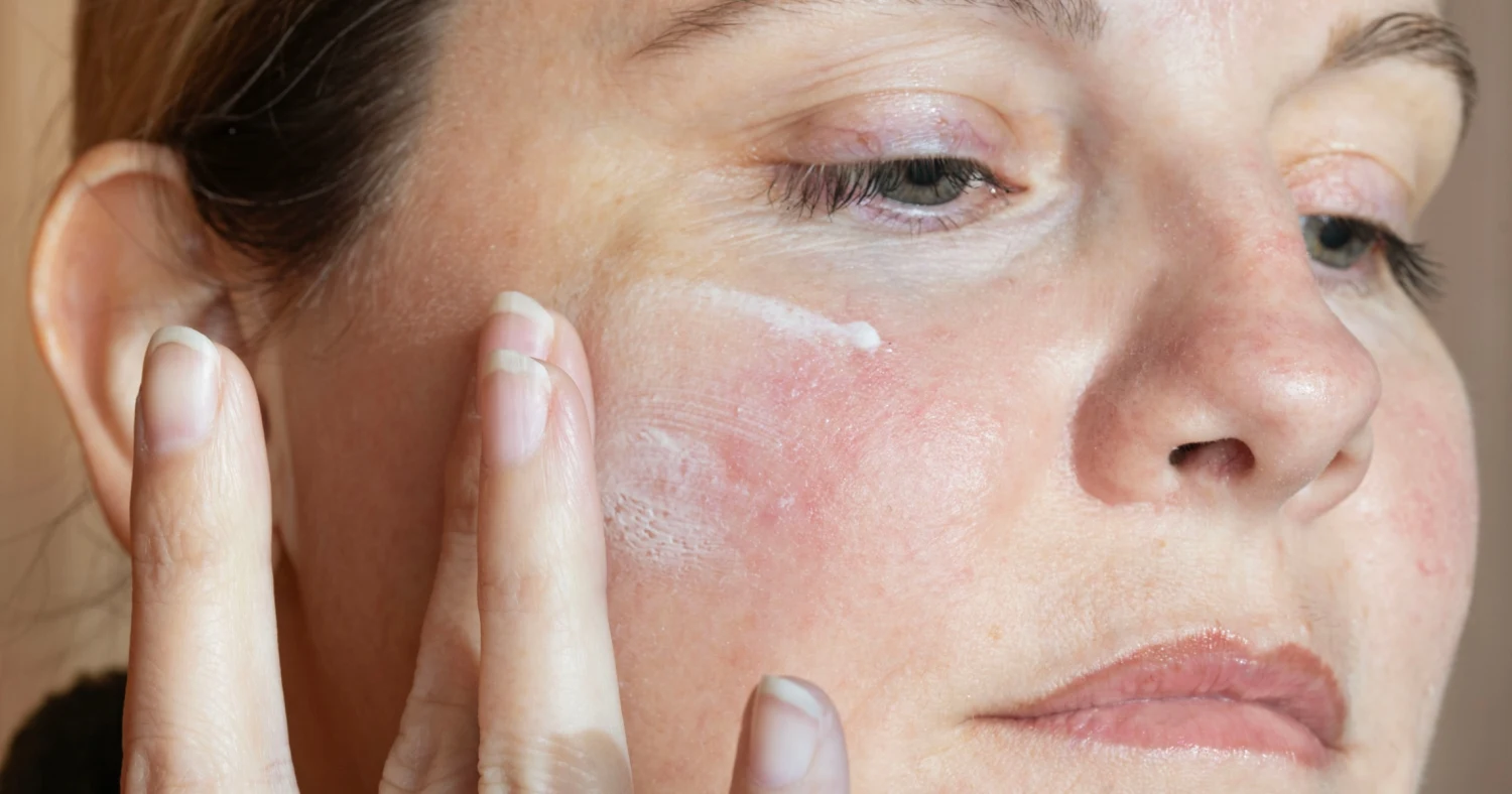 Rosacea