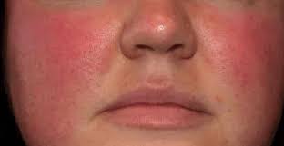 What Do Dermatologists Recommend for Rosacea? Expert Advice and Treatment Options